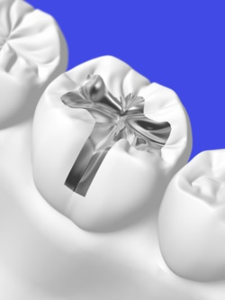 Amalgam-Plombe im Zahn