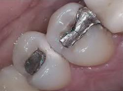 Amalgamfüllungen ermöglichen eine preiswerte Zahnrekonstruktion