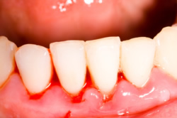Blutung und Schwellung des Zahnfleisches