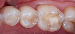 Mit Composite werden kleiner Zahndefekte repariert