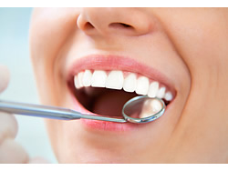 Entzündetes Zahnfleisch ist die Vorstufe einer Parodontose