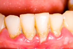 Gingivitis = Zahnfleischentzündung