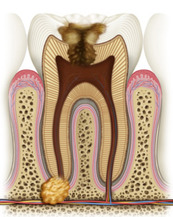 Karies-Wurzelentzündung-Zahnverlust