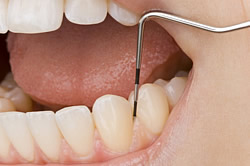 Parodontose - Messung der Tiefe der Zahnfleischtaschen mit Sonde durch Zahnärztin Anna Wojcik