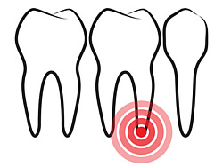 Eine Pulpitis ist die Entzündung des Zahnmarks