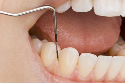 Blutendes Zahnfleisch muss dringend behandelt werden