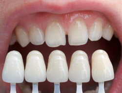 Veneers