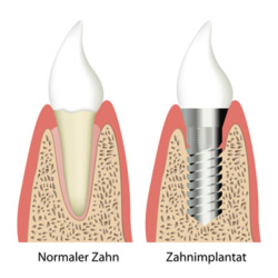 Vergleich gesunder Zahn - Implantat
