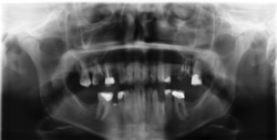 Zahnausfall durch schlechte Zahnversorgung