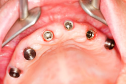Implantate im zahnlosen Oberkiefer