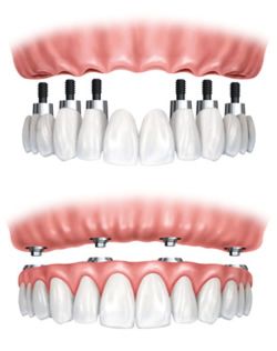 1.Implantatbrücke - 2.Implantatprothese