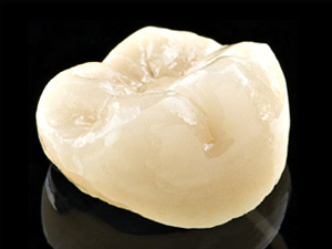 Eine Teilkrone fertigen wir mit CEREC in wenigen Minuten