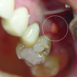 Eine Zahnfistel ist oft ein Zeichen für eine entzündete Zahnwurzel