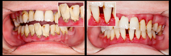 Vor und nach der Zahnfleischbehandlung