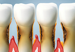 Eine Zahnfleischentzündung führt unbehandelt zu frühzeitigem Zahnverlust