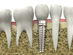 Zahnimplantat-Modell in Zahnreihe
