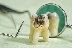 Karies-geschädigter Zahn