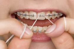 Zahnreinigung an den Brackets