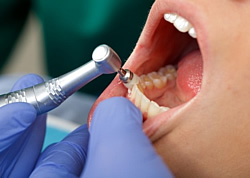 Zahnprophylaxe Zahnarzt