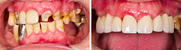 Zahnsanierung - Davor und danach