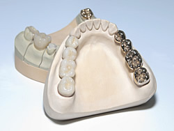 Zahnersatz aus Zirkonoxid ist optisch nicht von natürlichen Zähnen zu unterscheiden